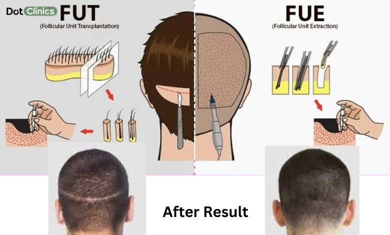 comparison procedure of FUE and FUT and Given after result