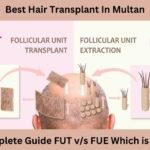 Comparison about FUE and FUT hair transplant giving full detail of procedure of both