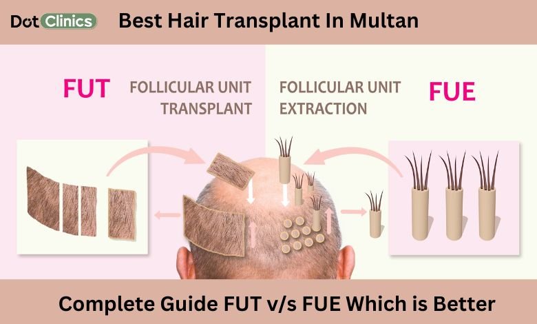 Comparison about FUE and FUT hair transplant giving full detail of procedure of both
