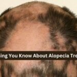 A main facing hair loss due alopecia disease in which every thing know about Alopecia treatment