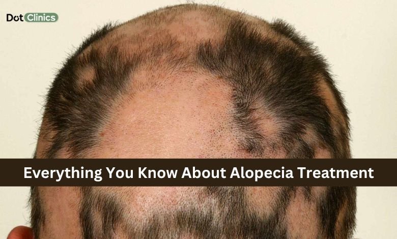 A main facing hair loss due alopecia disease in which every thing know about Alopecia treatment