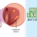 Prostate cancer diagram showing enlarged prostate with malignant tumors and bladder