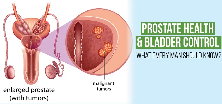 Prostate cancer diagram showing enlarged prostate with malignant tumors and bladder