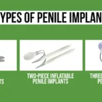 Types of penile implants: malleable, two-piece, and three-piece inflatable implant options.