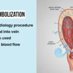 Venous leak embolization infographic showing non-surgical procedure restoring penile blood flow.