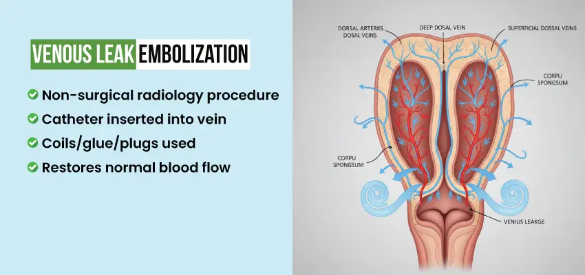 Venous leak embolization infographic showing non-surgical procedure restoring penile blood flow.