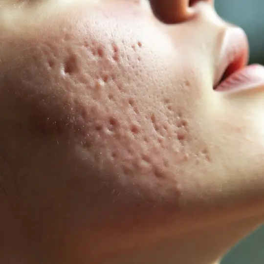 Acne scar treatment closeup showing pitted acne scars on cheek skin