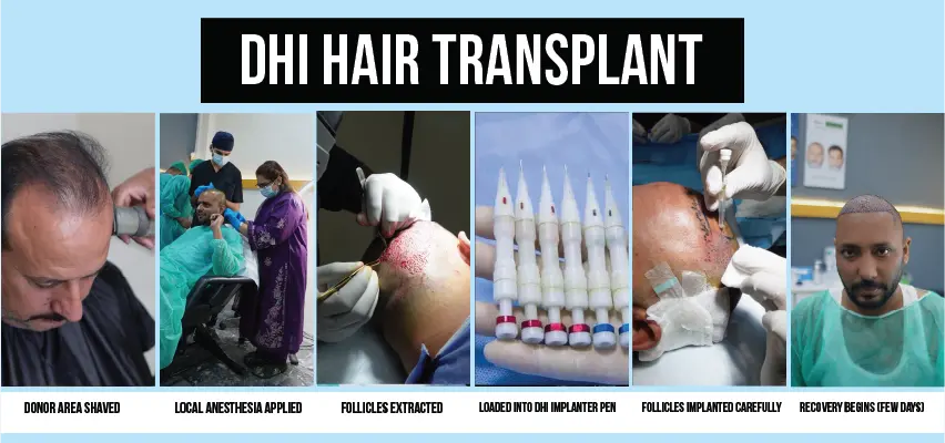 Clinical DHI hair transplant procedure using specialized implanter pen.