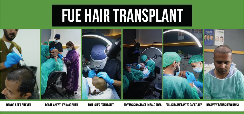 Step-by-step FUE hair transplant process from donor shaving to recovery.