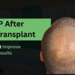 Man with thinning crown and text overlay about PRP benefits after hair transplant.