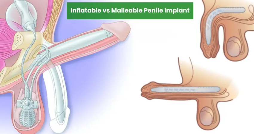 Inflatable vs malleable penile implant comparison showing surgical placement and device structure