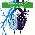 Main causes of varicoceles showing normal vs enlarged twisted testicular veins in scrotal region