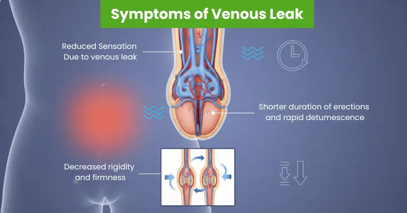 Symptoms of venous leak: reduced sensation, shorter erections, decreased rigidity and rapid detumescence