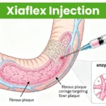 Xiaflex injection targeting fibrous plaque in Peyronie's disease showing enzymatic collagen breakdown