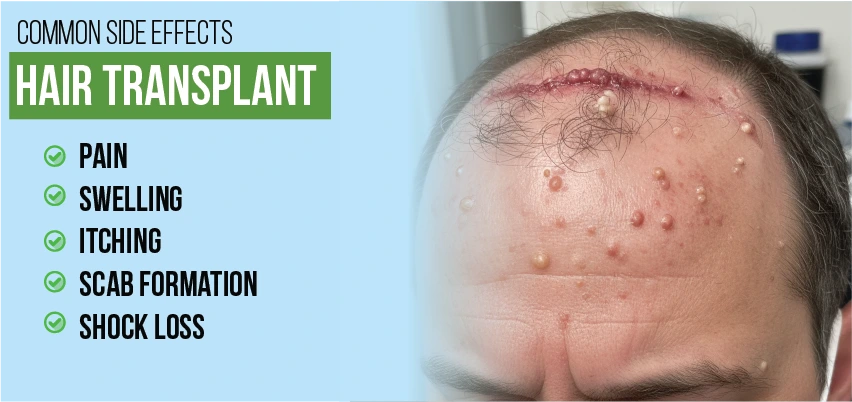 Common hair transplant side effects: pain, swelling, itching, scab, shock loss