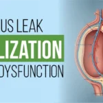 Anatomical diagram of venous leak embolization for erectile dysfunction