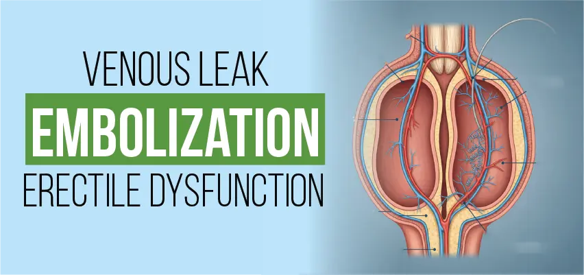 Anatomical diagram of venous leak embolization for erectile dysfunction