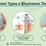 Types of Shockwave Therapy: RSWT, FSWT & Planar for ED, Tendinopathies & Musculoskeletal Pain Relief